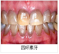 烤瓷牙失败