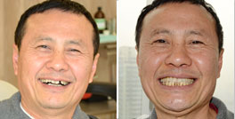 叶先生侧切牙缺失案例
